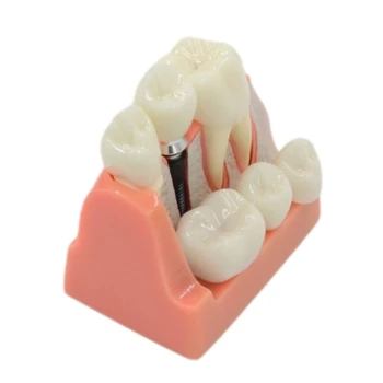 Dropship Dental Teeth Model 4-szeres implantátum PVC modell fogorvos hallgatók bemutatójához